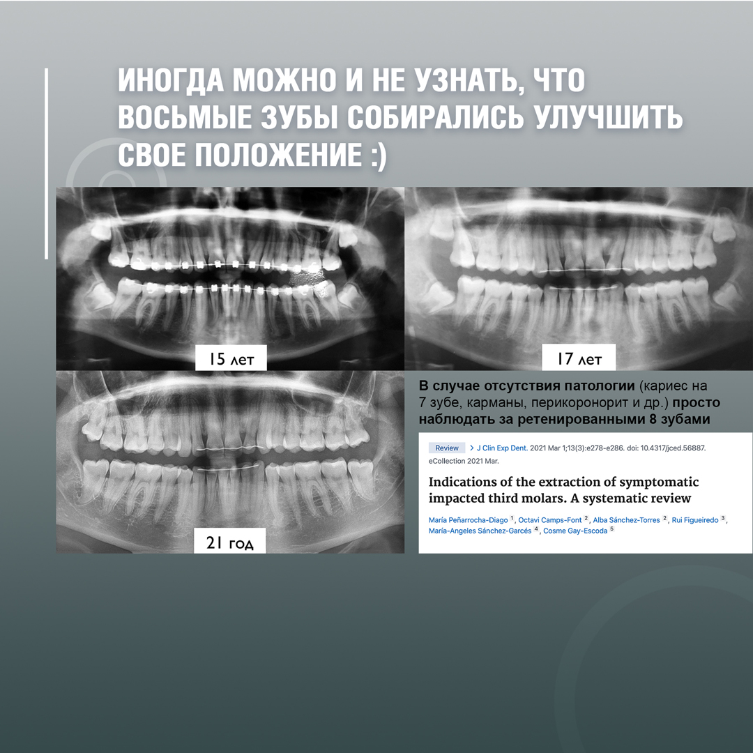 Восьмые зубы надо удалять всегда – иначе будут проблемы по жизни! -  интересно об ортодонтии, имплантации и протезировании зубов